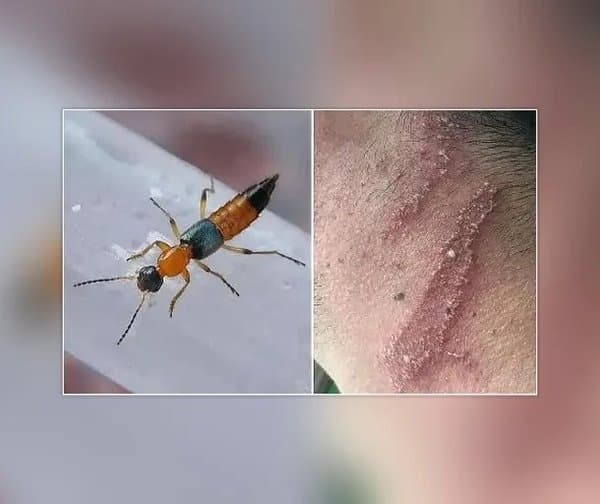 యాసిడ్ పురుగులతో జాగ్రత్త: వైద్యుల హెచ్చరిక