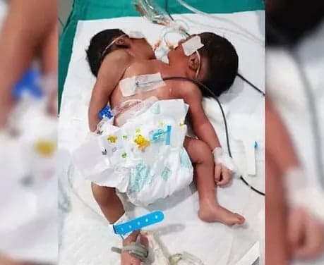 ఒడిశాలో రెండు తలల శిశువు జననం