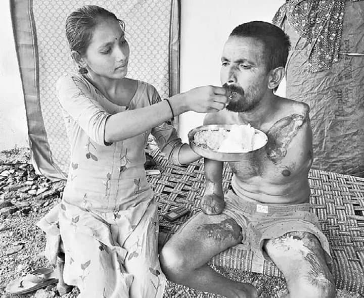 విద్యుదాఘాతంతో రెండు చేతులు కోల్పోయి