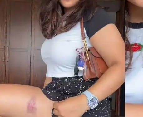 సీజేపీ నిరసనలో జైన్‌ మేరీకి గాయాలు