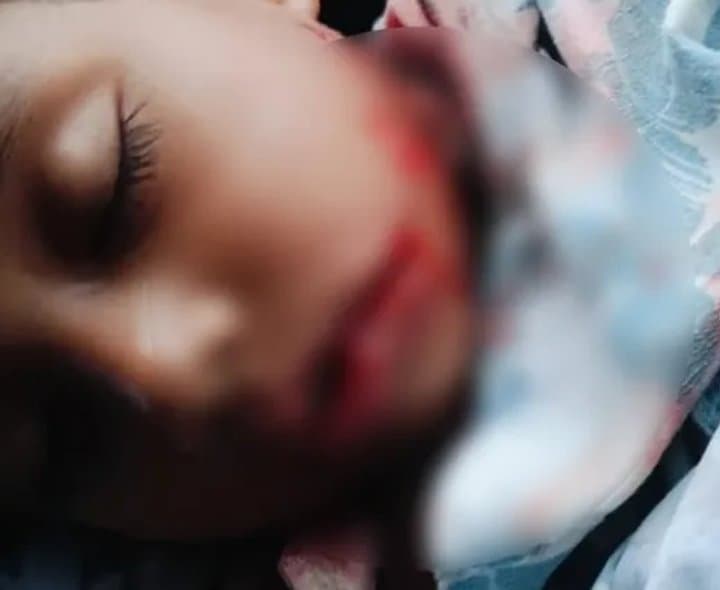 బాన్సువాడలో చిన్నారిపై వీధి కుక్కల దాడి
