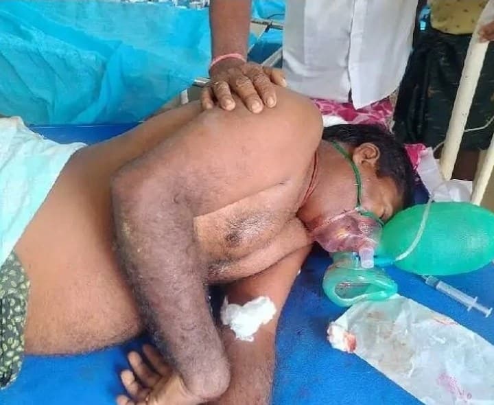 పాము కాటుకు గురైన రైతు - Udayam