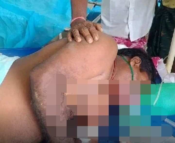 పాము కాటుకు వ్యక్తి అస్వస్థత - Udayam