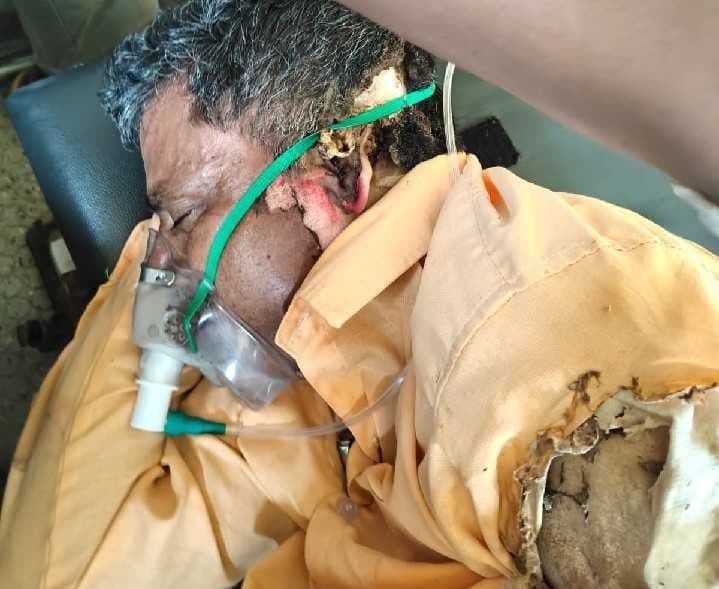 దోమలో విద్యుత్ షాక్తో లైన్మెన్కు గాయాలు - Udayam